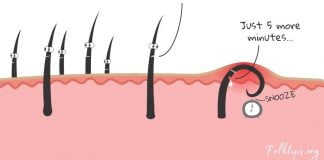 5 მარტივი და სახლის პირობებში დამზადებული საშუალება ჩაბრუნებული თმის საწინააღმდეგოდ
