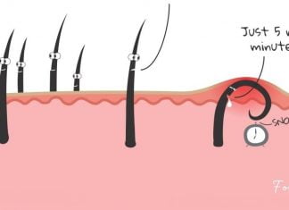 5 მარტივი და სახლის პირობებში დამზადებული საშუალება ჩაბრუნებული თმის საწინააღმდეგოდ