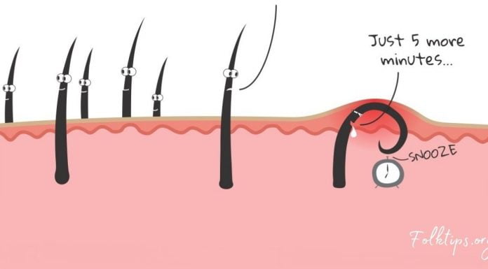 5 მარტივი და სახლის პირობებში დამზადებული საშუალება ჩაბრუნებული თმის საწინააღმდეგოდ