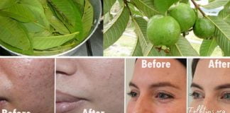 გამოიყენეთ გუავას ფოთლები, რომ მოიცილოთ ნაოჭები, აკნე, მუქი ლაქები და კანის ალერგიული რეაქციები!