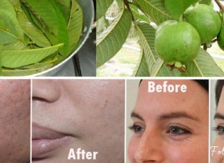 გამოიყენეთ გუავას ფოთლები, რომ მოიცილოთ ნაოჭები, აკნე, მუქი ლაქები და კანის ალერგიული რეაქციები!