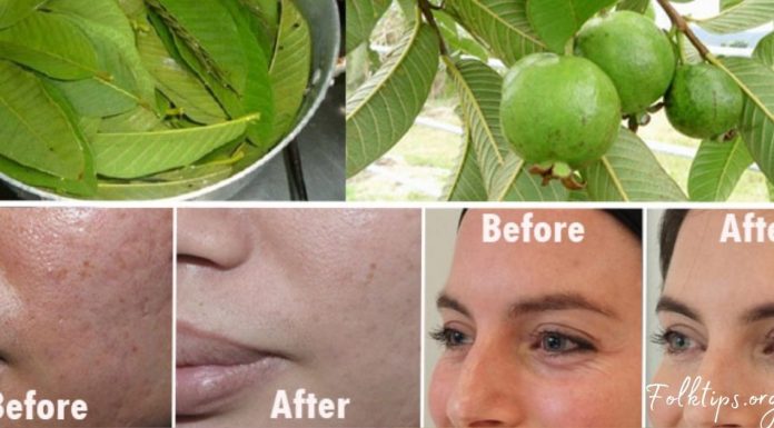 გამოიყენეთ გუავას ფოთლები, რომ მოიცილოთ ნაოჭები, აკნე, მუქი ლაქები და კანის ალერგიული რეაქციები!
