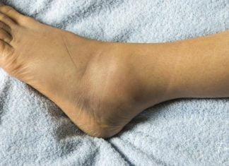 7 წესი, თუ რა უნდა ქნათ ფეხების შეშუპების დროს! ეს აუცილებლად დაგეხმარებათ!