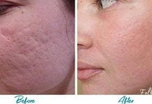 აი ასე უნდა მოვიშოროთ აკნესგან დატოვებული ნაიარევი ნატურალური პროდუქტების დახმარებით!