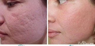 აი ასე უნდა მოვიშოროთ აკნესგან დატოვებული ნაიარევი ნატურალური პროდუქტების დახმარებით!