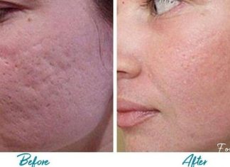 აი ასე უნდა მოვიშოროთ აკნესგან დატოვებული ნაიარევი ნატურალური პროდუქტების დახმარებით!