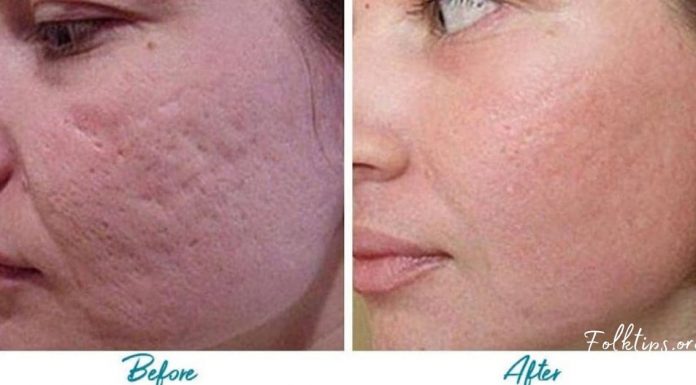 აი ასე უნდა მოვიშოროთ აკნესგან დატოვებული ნაიარევი ნატურალური პროდუქტების დახმარებით!