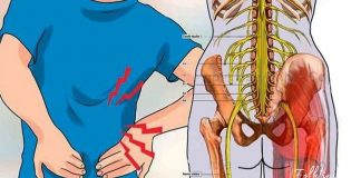 იმკურნალეთ სახლის პირობებში ნერვის ანთების დროს!