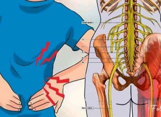 იმკურნალეთ სახლის პირობებში ნერვის ანთების დროს!