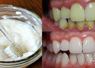 ამ მეთოდის გამოყენებით მარტივად მოიშორებთ ნადებს და გაისუფთავებთ კბილებს-ეფექტურია!