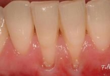 ღრძილის რეტრაქციას ეს 4 ინგრედიენტი შველის! რთული პრობლემის მარტივი გადაწყვეტა!