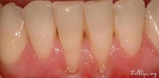 ღრძილის რეტრაქციას ეს 4 ინგრედიენტი შველის! რთული პრობლემის მარტივი გადაწყვეტა!