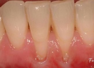 ღრძილის რეტრაქციას ეს 4 ინგრედიენტი შველის! რთული პრობლემის მარტივი გადაწყვეტა!