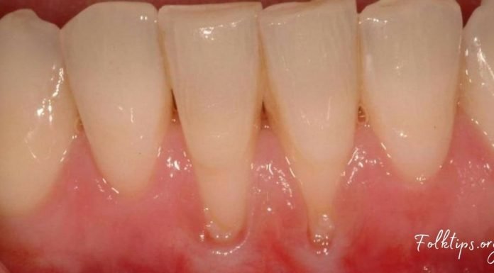 ღრძილის რეტრაქციას ეს 4 ინგრედიენტი შველის! რთული პრობლემის მარტივი გადაწყვეტა!