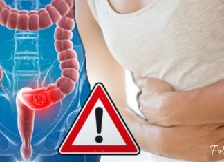 მსხვილი ნაწლავის 7 სიმპტომი, რაც ყველამ უნდა იცოდეს! იზრუნეთ თქვენს ჯანმრთელობაზე!