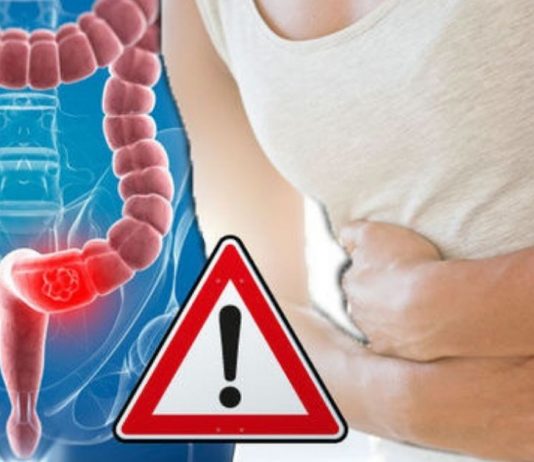 მსხვილი ნაწლავის 7 სიმპტომი, რაც ყველამ უნდა იცოდეს! იზრუნეთ თქვენს ჯანმრთელობაზე!