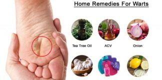 7 ბუნებრივი საშუალება, რომელიც ეფექტურად დაგეხმარებათ კოჟრების მოშორებაში-გაიგეთ მეტი