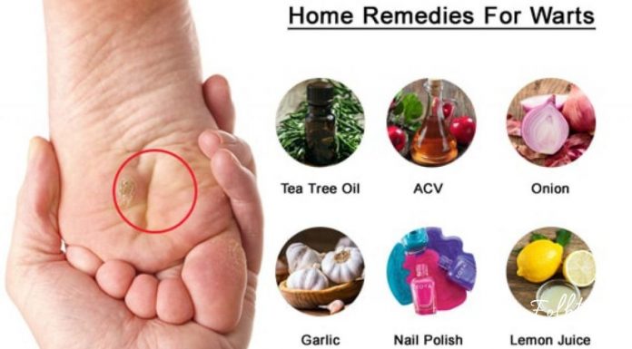 7 ბუნებრივი საშუალება, რომელიც ეფექტურად დაგეხმარებათ კოჟრების მოშორებაში-გაიგეთ მეტი