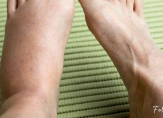 შეშუპებული კიდურების სამკურნალო ბუნებრივი მეთოდები- ეფექტურია!