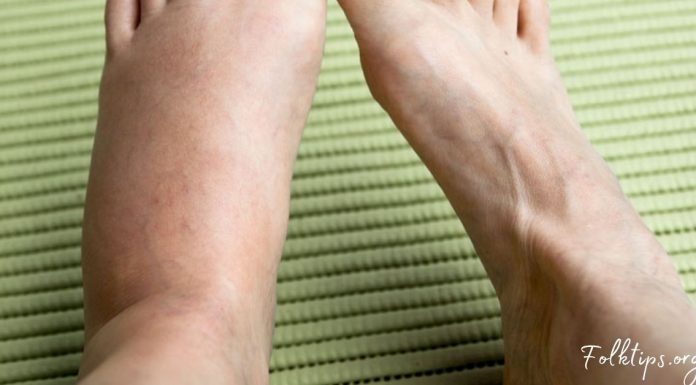 შეშუპებული კიდურების სამკურნალო ბუნებრივი მეთოდები- ეფექტურია!