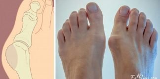 8 ნატურალური საშუალება ტერფის ვალგუსური დეფორმაციის გასაკურნებლად!