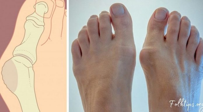 8 ნატურალური საშუალება ტერფის ვალგუსური დეფორმაციის გასაკურნებლად!