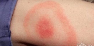 თუ თქვენ ხელზე ამგვარ ლაქას შეამჩნევთ, აუცილებლად მიმართეთ ექიმს!