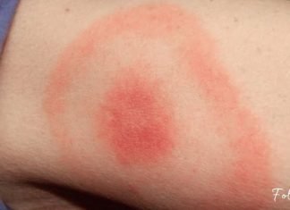 თუ თქვენ ხელზე ამგვარ ლაქას შეამჩნევთ, აუცილებლად მიმართეთ ექიმს!