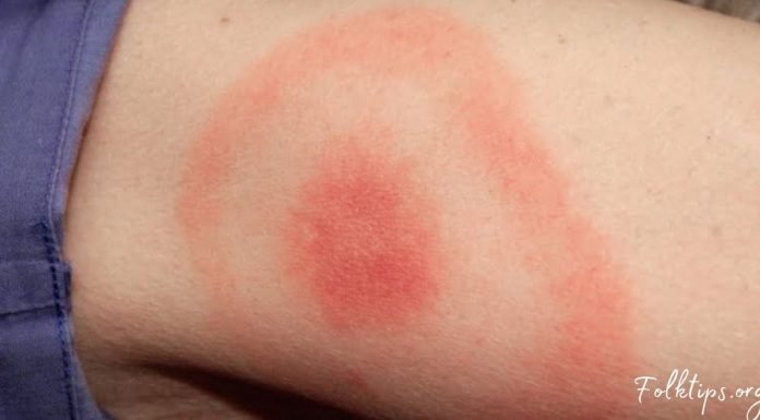 თუ თქვენ ხელზე ამგვარ ლაქას შეამჩნევთ, აუცილებლად მიმართეთ ექიმს!