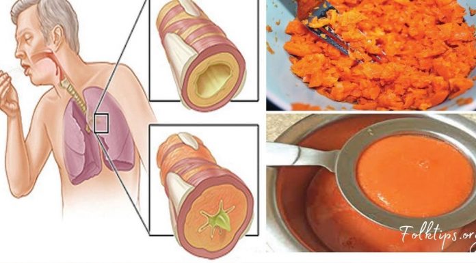 ორინგრედიენტიანი სიროფი, რომელიც ხველას მოგიხსნით და ფილტვებიდან ლორწოს გააქრობს!