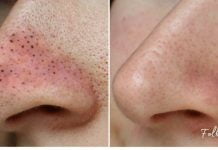 მოიშორეთ შავი წერტილები უმარტივესად-ეფექტური მეთოდი თქვენთვის!