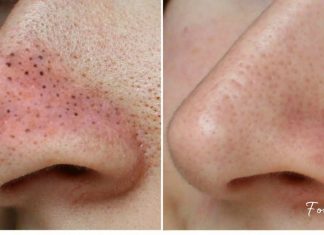 მოიშორეთ შავი წერტილები უმარტივესად-ეფექტური მეთოდი თქვენთვის!