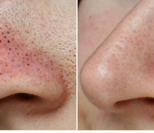 მოიშორეთ შავი წერტილები უმარტივესად-ეფექტური მეთოდი თქვენთვის!