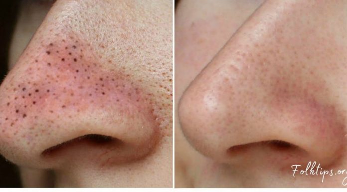 მოიშორეთ შავი წერტილები უმარტივესად-ეფექტური მეთოდი თქვენთვის!