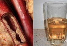 გაისუფთავეთ არტერიები მარტივად- სცადეთ საოცრად ეფექტური სასმელი