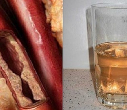 გაისუფთავეთ არტერიები მარტივად- სცადეთ საოცრად ეფექტური სასმელი