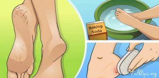 დახეთქილ ქუსლებსა და კოჟრს ის მარტივი ინგრედიენტი შველის, რომელიც ყველას სახლში გვაქვს!