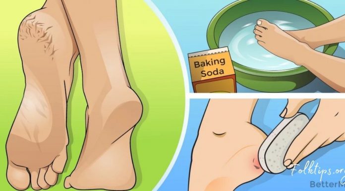 დახეთქილ ქუსლებსა და კოჟრს ის მარტივი ინგრედიენტი შველის, რომელიც ყველას სახლში გვაქვს!