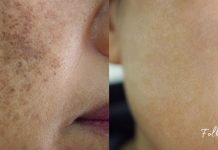 როგორ მოვიშოროთ ასაკისგან გამოწვეული პიგმენტური ლაქები სახლში დამზადებული საშუალებით?