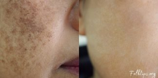 როგორ მოვიშოროთ ასაკისგან გამოწვეული პიგმენტური ლაქები სახლში დამზადებული საშუალებით?