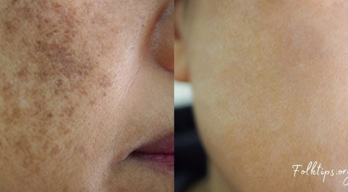 როგორ მოვიშოროთ ასაკისგან გამოწვეული პიგმენტური ლაქები სახლში დამზადებული საშუალებით?