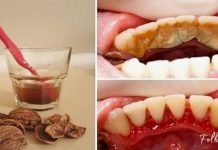 როგორ მოვიშოროთ კბილებიდან ქვები და ნადები მარტივად? ეს მეთოდი დაგეხმარებათ!