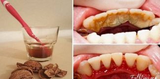 როგორ მოვიშოროთ კბილებიდან ქვები და ნადები მარტივად? ეს მეთოდი დაგეხმარებათ!