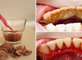 როგორ მოვიშოროთ კბილებიდან ქვები და ნადები მარტივად? ეს მეთოდი დაგეხმარებათ!