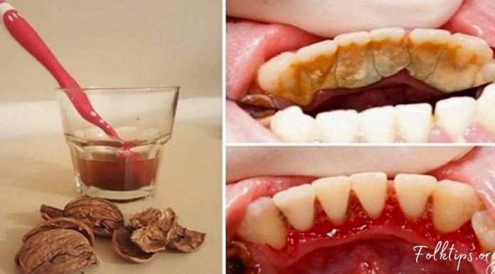 როგორ მოვიშოროთ კბილებიდან ქვები და ნადები მარტივად? ეს მეთოდი დაგეხმარებათ!