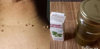 პაპილომების მოშორება ამ ხალხური საშუალებებით ყველაზე მარტივია. სცადეთ!