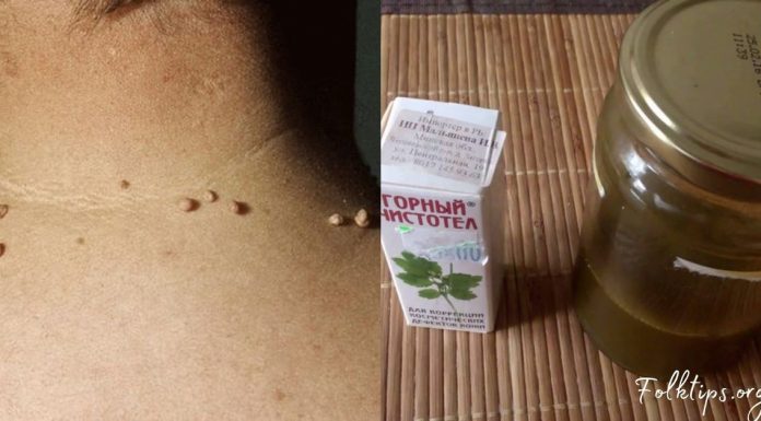 პაპილომების მოშორება ამ ხალხური საშუალებებით ყველაზე მარტივია. სცადეთ!