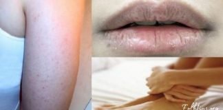 კანი გიშრებათ? თმა გცვივათ? აი, რომელი ვიტამინი გაკლიათ. ეს ყველასთვის საჭიროა