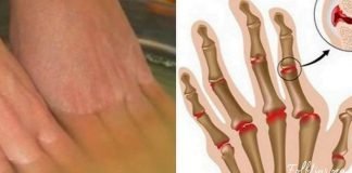 ვაშლის ძმარი ართრიტის წინააღმდეგ, ეს უნდა იცოდეთ !