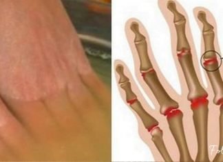 ვაშლის ძმარი ართრიტის წინააღმდეგ, ეს უნდა იცოდეთ !